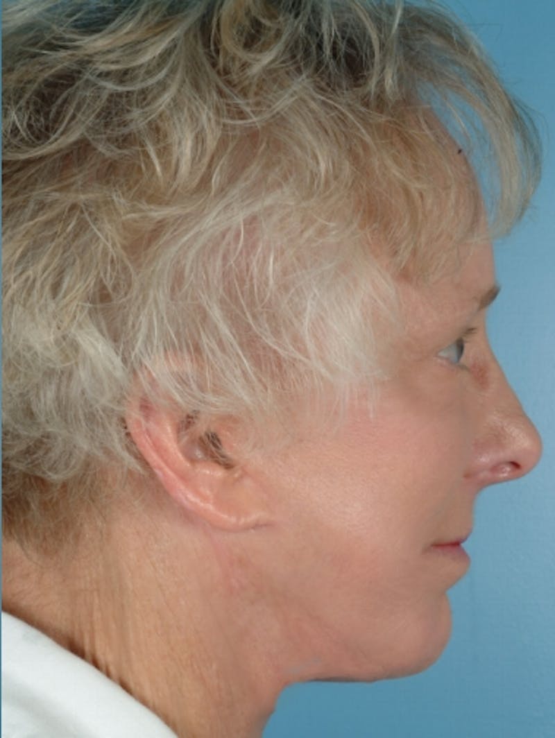 Brow Lift Before & After Gallery - Patient 200131 - Image 4