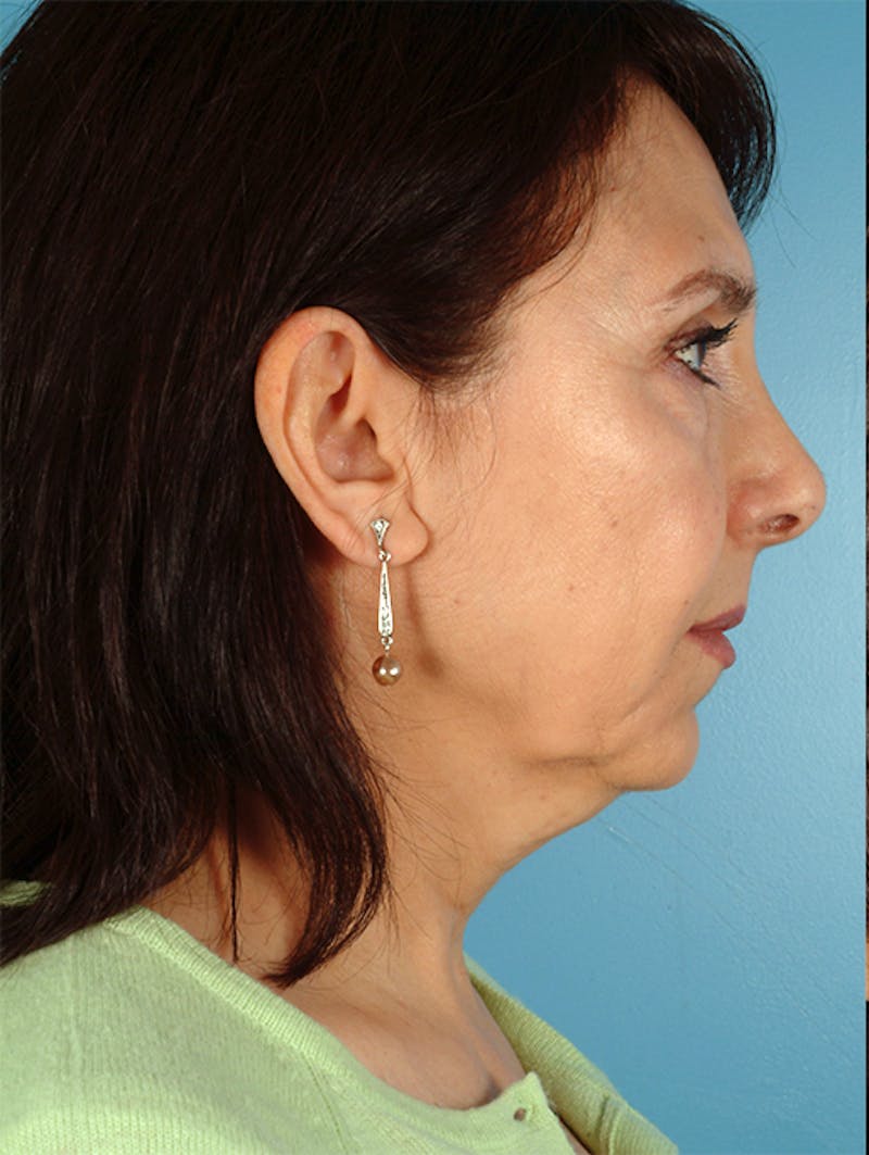 Chin Implant Before & After Gallery - Patient 245037 - Image 5