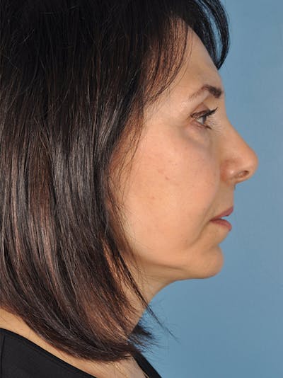 Brow Lift Before & After Gallery - Patient 206452 - Image 2