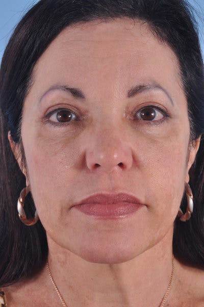 Brow Lift Before & After Gallery - Patient 340853 - Image 2
