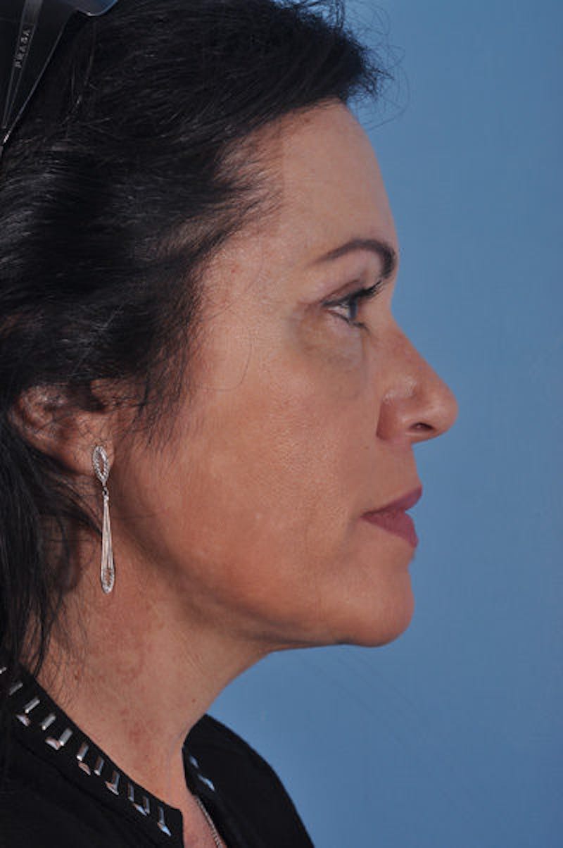 Brow Lift Before & After Gallery - Patient 340853 - Image 4
