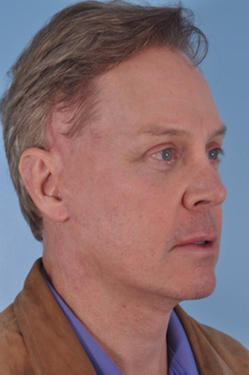 Neck Lift Before & After Gallery - Patient 976748 - Image 6