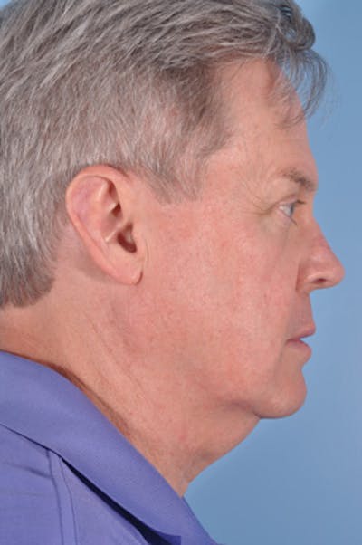 Liposuction Submental Before & After Gallery - Patient 324167 - Image 1