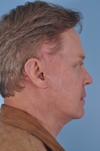 Liposuction Submental Before & After Gallery - Patient 324167 - Image 2