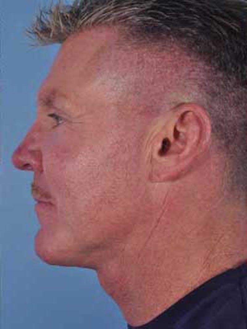 Cheek Implants Before & After Gallery - Patient 282743 - Image 6