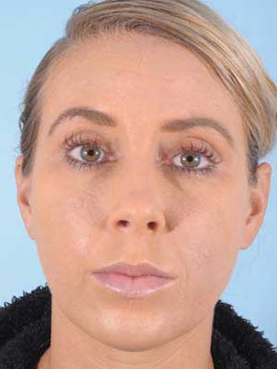 Cheek Implants Before & After Gallery - Patient 186143 - Image 1