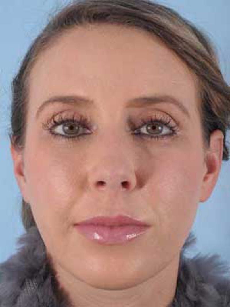 Cheek Implants Before & After Gallery - Patient 186143 - Image 2