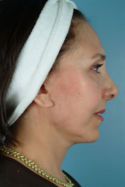 Chin Implant Before & After Gallery - Patient 245037 - Image 2