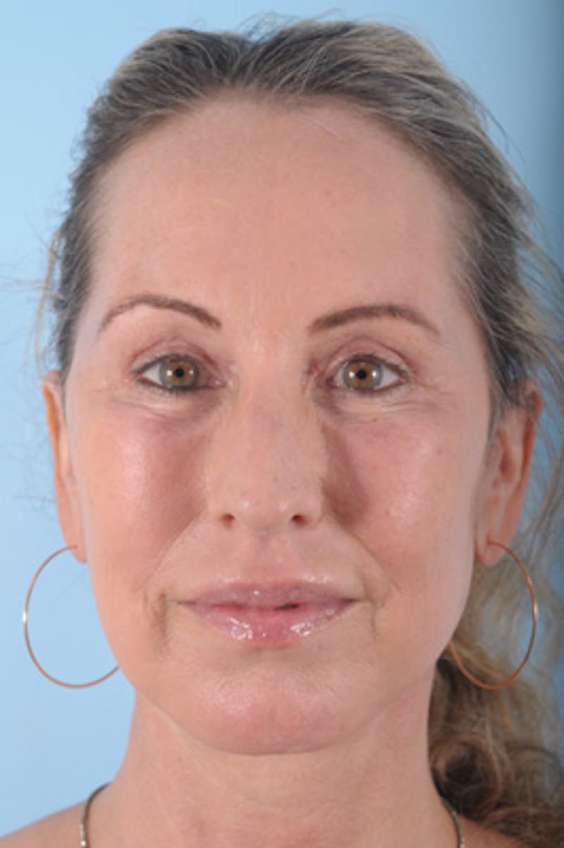 Chin Implant Before & After Gallery - Patient 287593 - Image 4