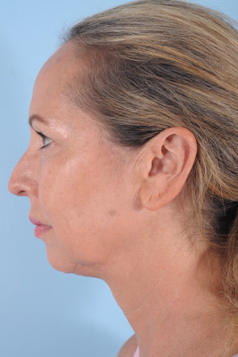 Chin Implant Before & After Gallery - Patient 287593 - Image 1