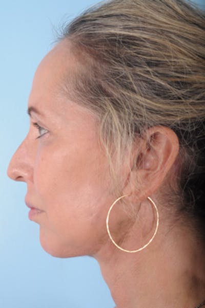 Chin Implant Before & After Gallery - Patient 287593 - Image 2