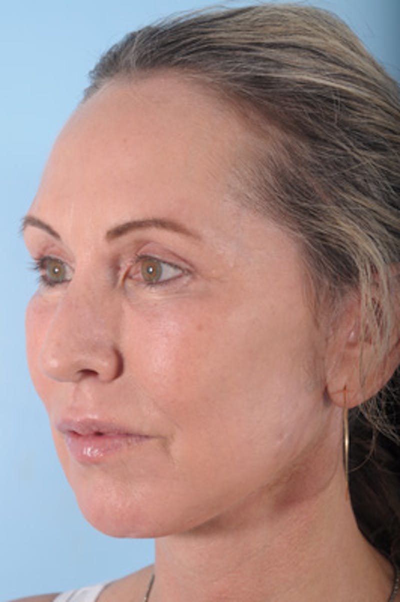 Chin Implant Before & After Gallery - Patient 287593 - Image 6