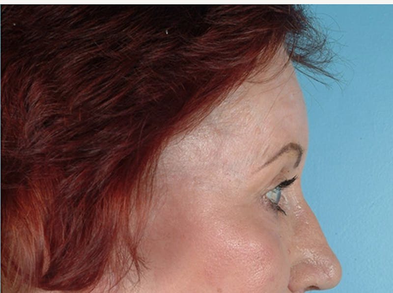 Brow Lift Before & After Gallery - Patient 335755 - Image 2