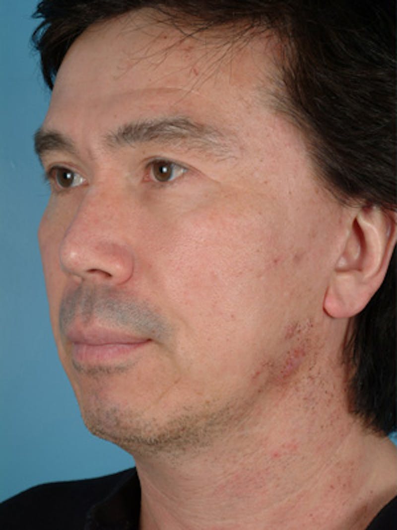 Chin Implant Before & After Gallery - Patient 124053 - Image 5