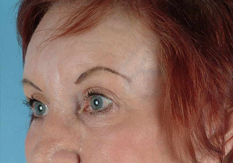 Brow Lift Before & After Gallery - Patient 335755 - Image 4