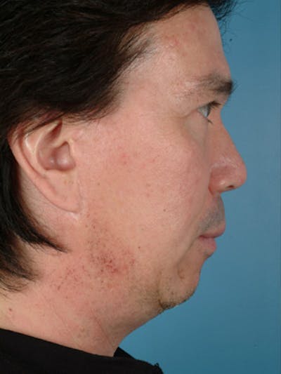 Chin Implant Before & After Gallery - Patient 124053 - Image 1