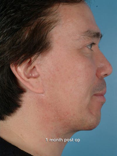 Liposuction Submental Before & After Gallery - Patient 110617 - Image 2