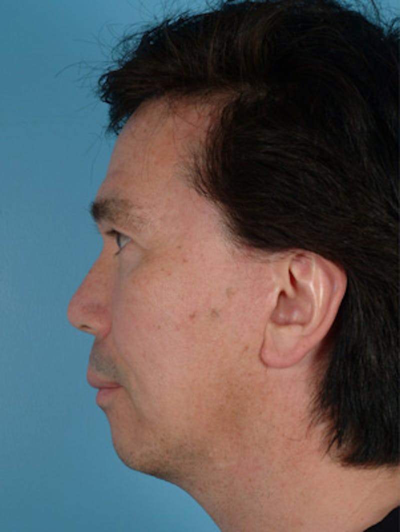 Chin Implant Before & After Gallery - Patient 124053 - Image 7