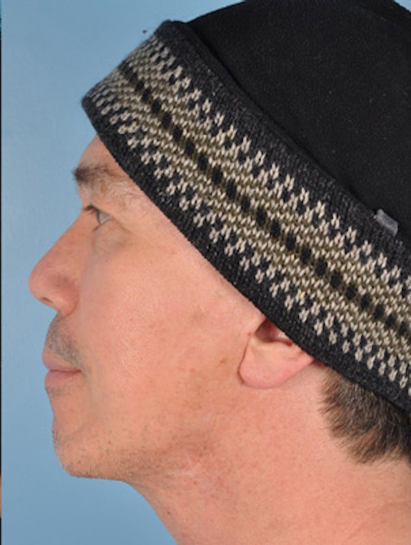 Chin Implant Before & After Gallery - Patient 124053 - Image 8