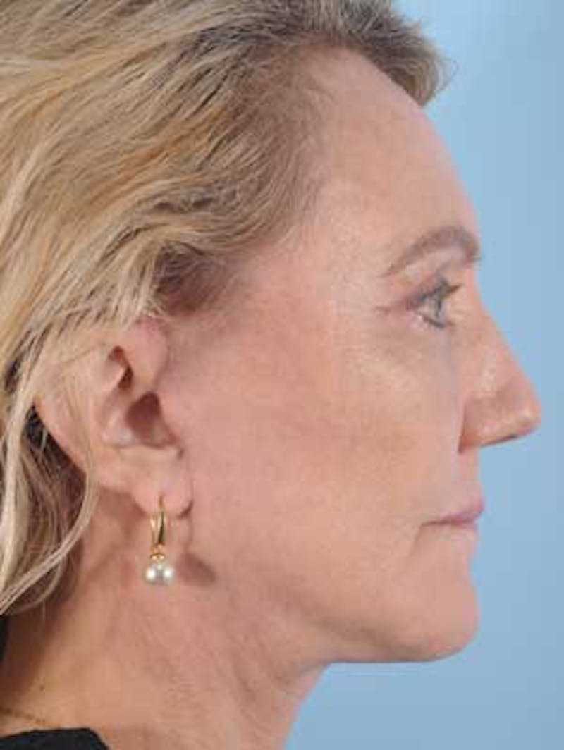 Chin Implant Before & After Gallery - Patient 388547 - Image 2