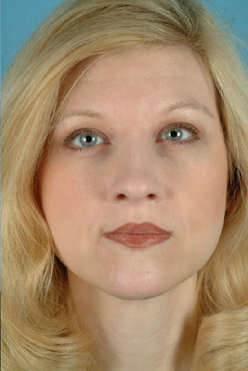 Lip Lift / Implants Before & After Gallery - Patient 135586 - Image 2