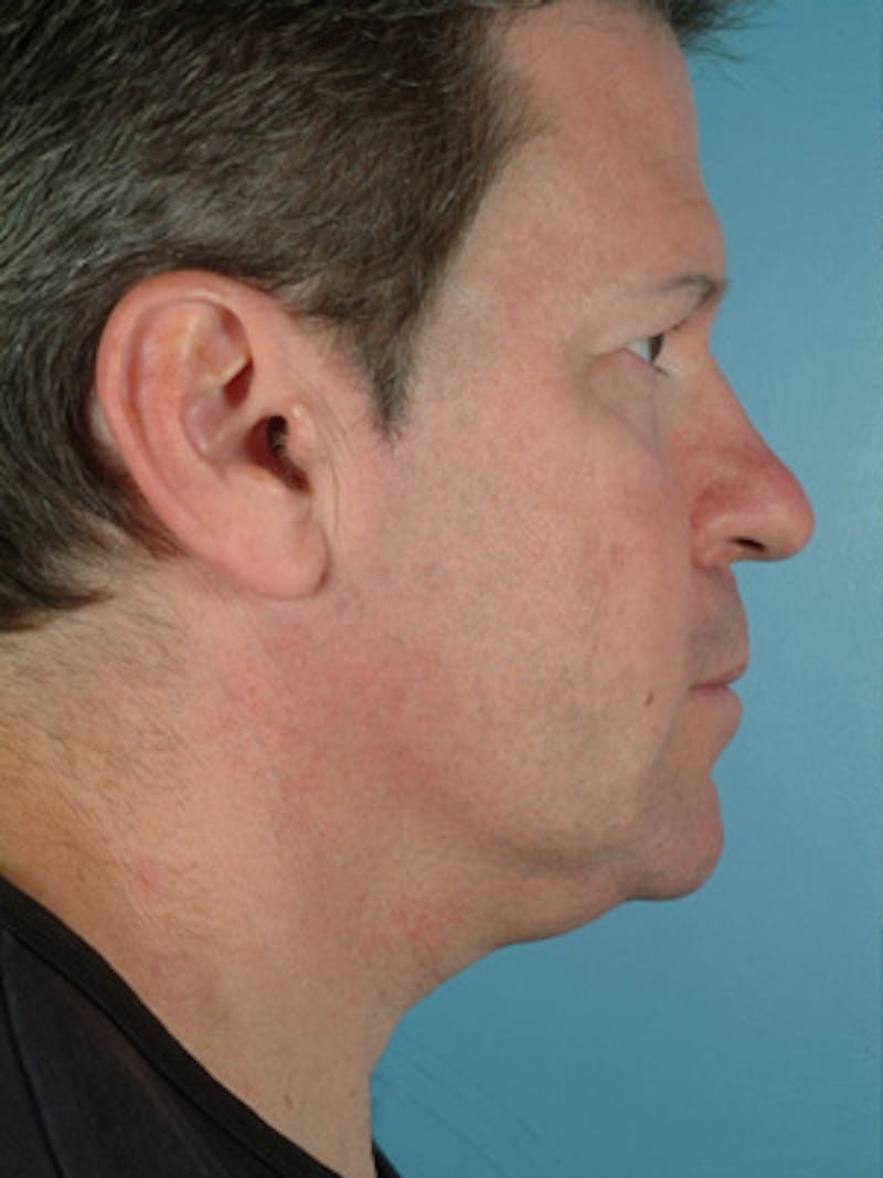 Lip Lift / Implants Before & After Gallery - Patient 470901 - Image 3