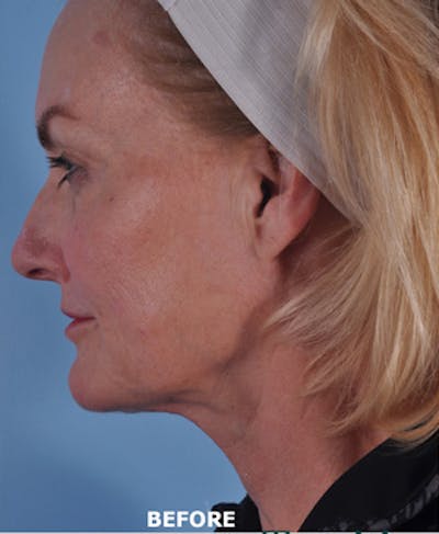Lip Lift / Implants Before & After Gallery - Patient 426406 - Image 1