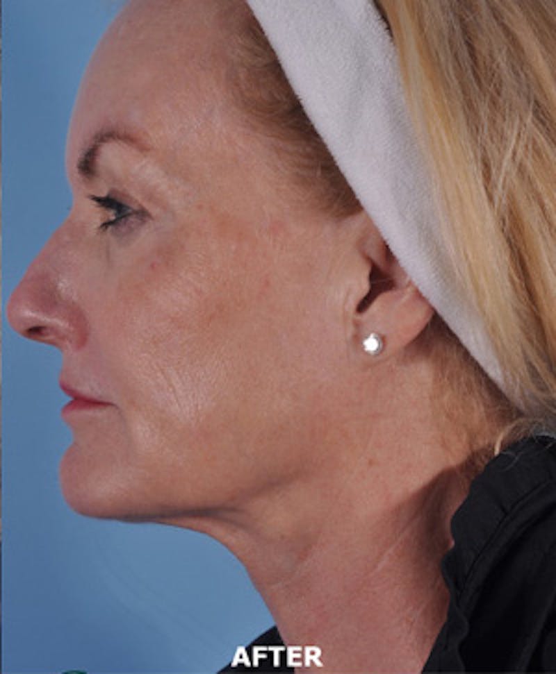 Lip Lift / Implants Before & After Gallery - Patient 426406 - Image 2