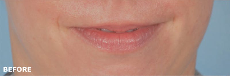 Lip Lift / Implants Before & After Gallery - Patient 188345 - Image 1