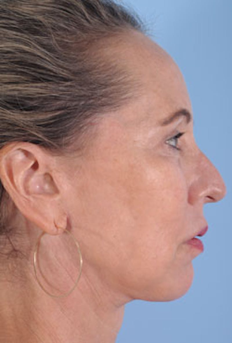 Lower Blepharoplasty Before & After Gallery - Patient 251203 - Image 4
