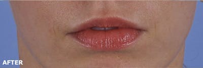 Lip Lift / Implants Before & After Gallery - Patient 188345 - Image 2