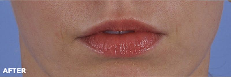 Lip Lift / Implants Before & After Gallery - Patient 188345 - Image 2