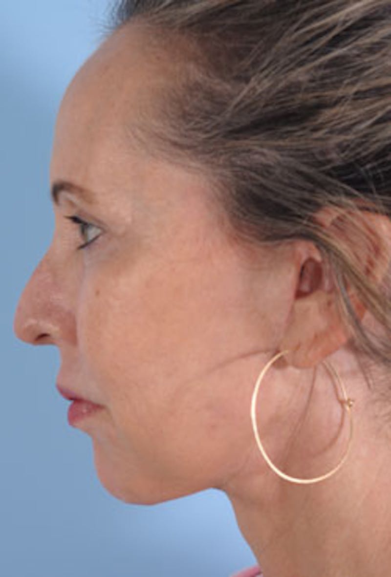 Lower Blepharoplasty Before & After Gallery - Patient 251203 - Image 6