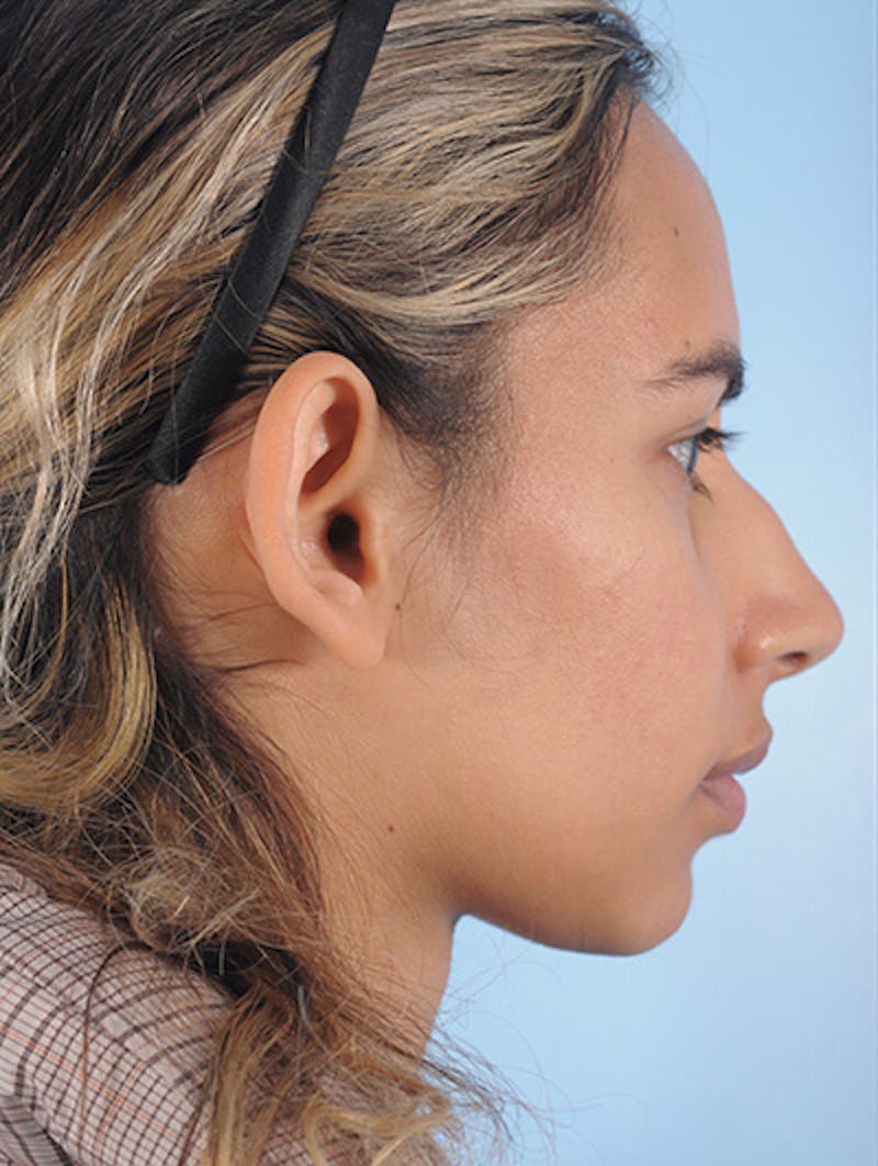Otoplasty (Ear Surgery) Before & After Gallery - Patient 605575 - Image 3