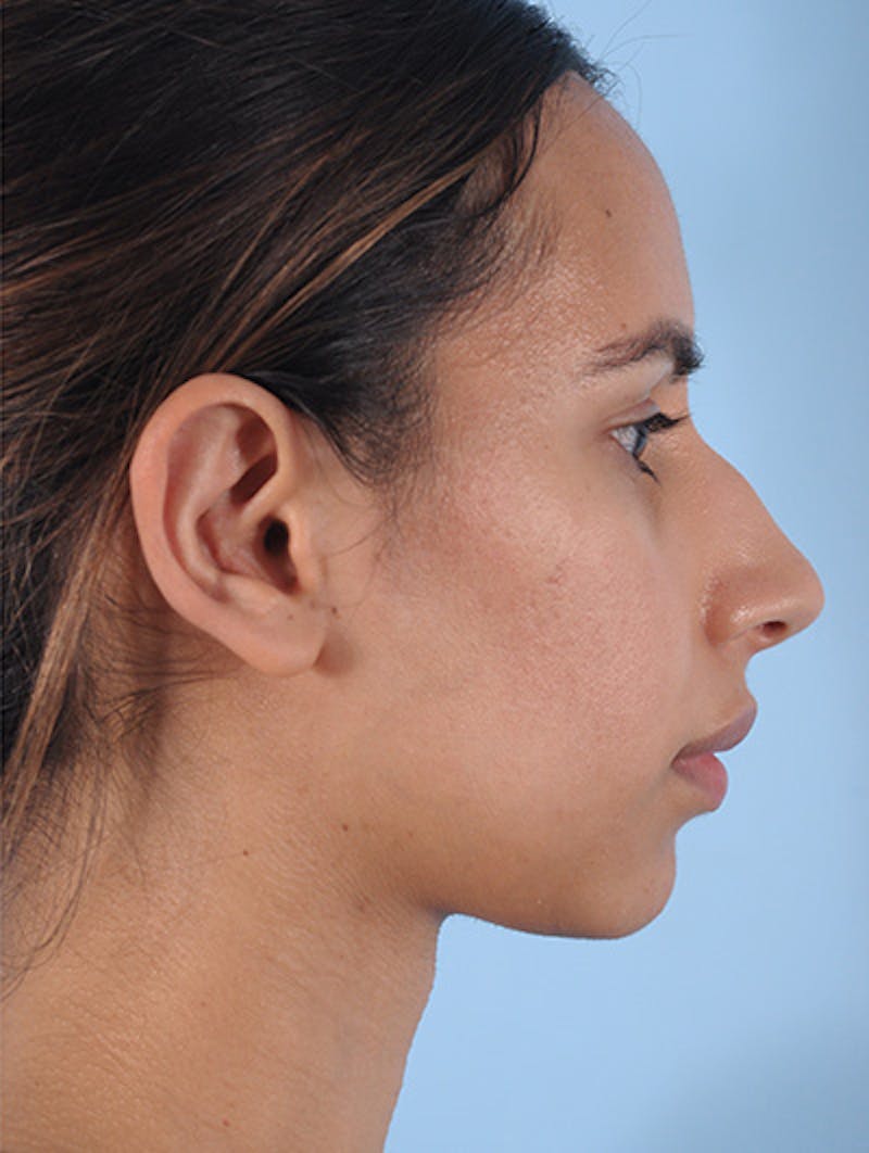 Otoplasty (Ear Surgery) Before & After Gallery - Patient 605575 - Image 4