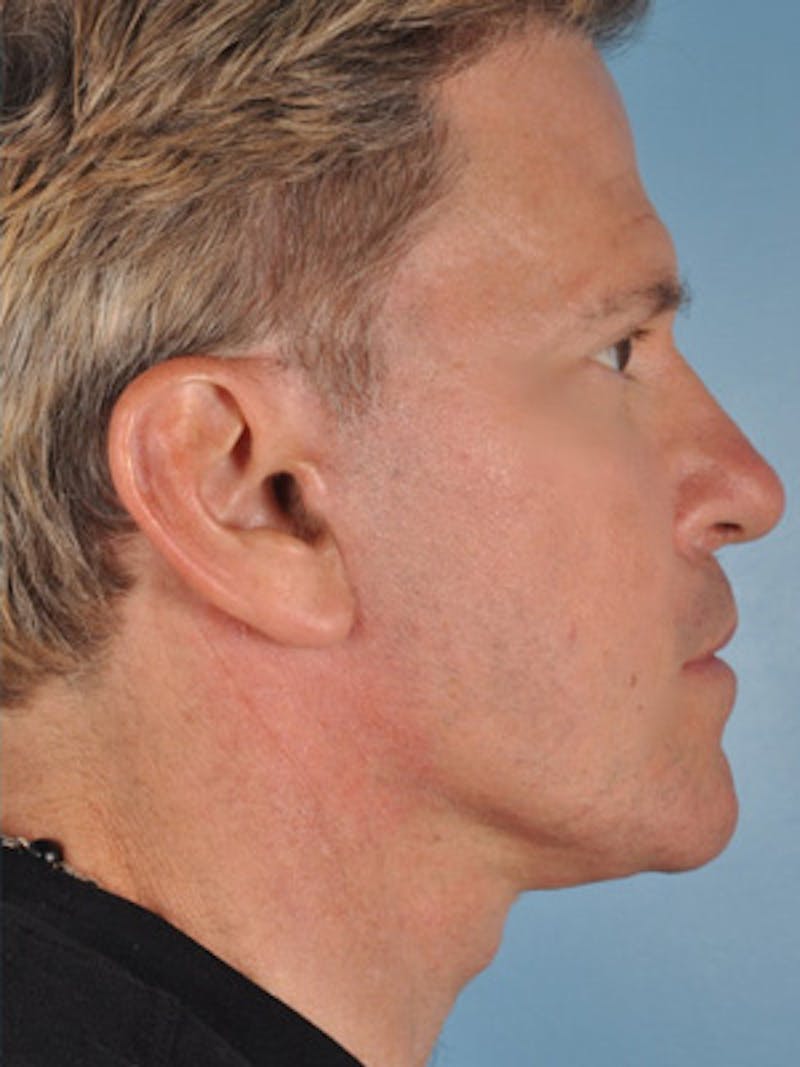Neck Lift Before & After Gallery - Patient 161928 - Image 2