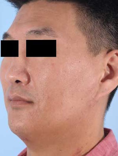 Liposuction Submental Before & After Gallery - Patient 384984 - Image 1
