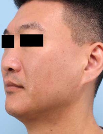 Liposuction Submental Before & After Gallery - Patient 384984 - Image 2