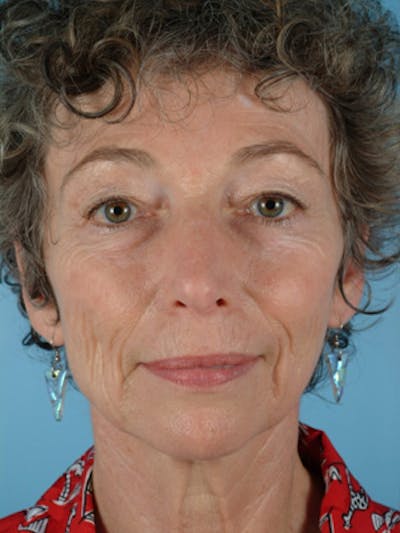 Neck Lift Before & After Gallery - Patient 179490 - Image 1
