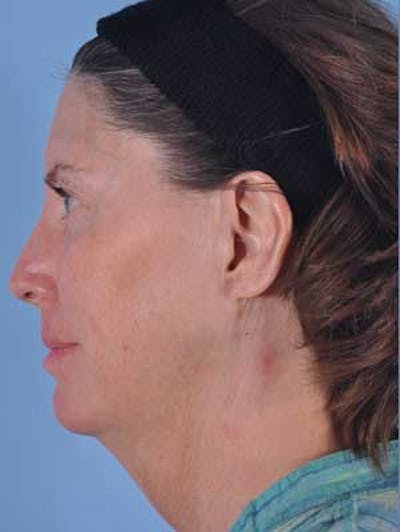 Liposuction Submental Before & After Gallery - Patient 148949 - Image 1