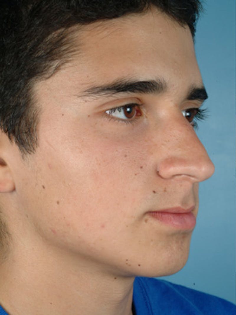 Rhinoplasty Before & After Gallery - Patient 307872 - Image 5