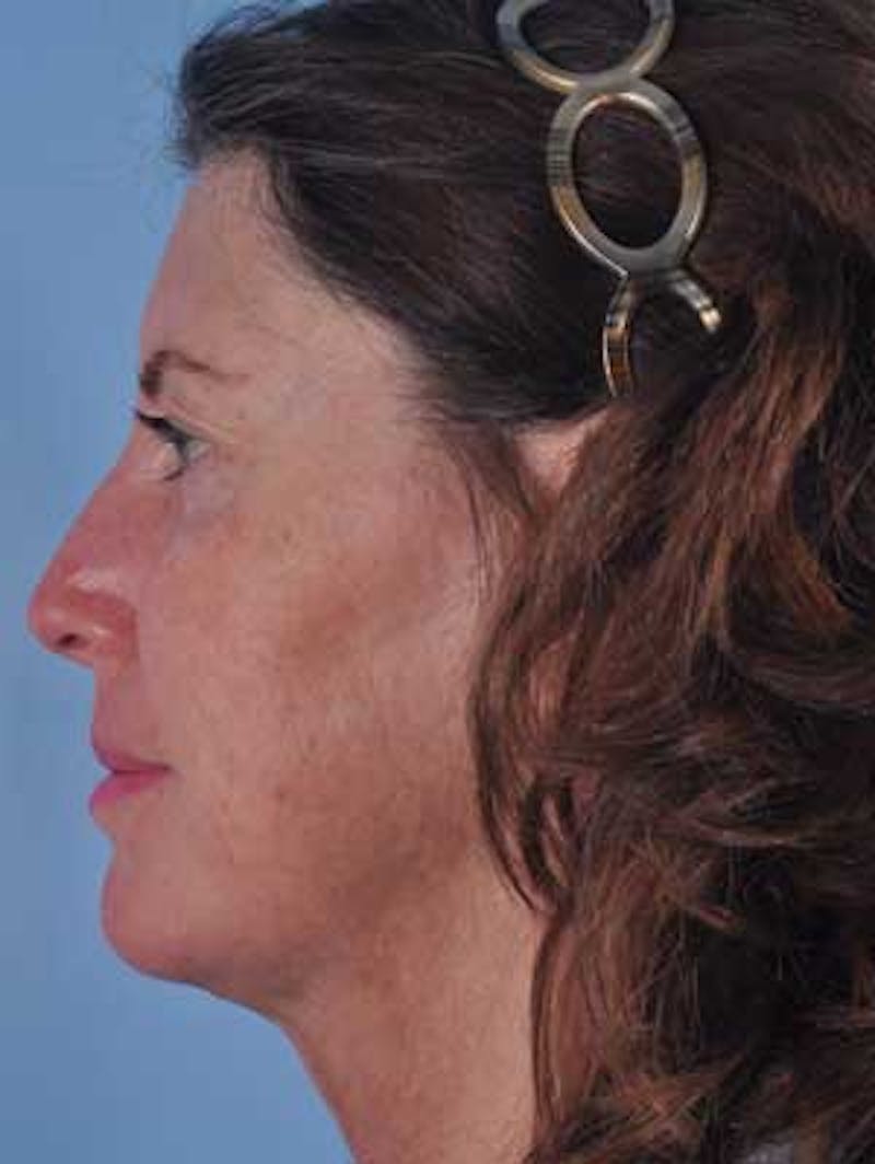 Liposuction Submental Before & After Gallery - Patient 148949 - Image 2