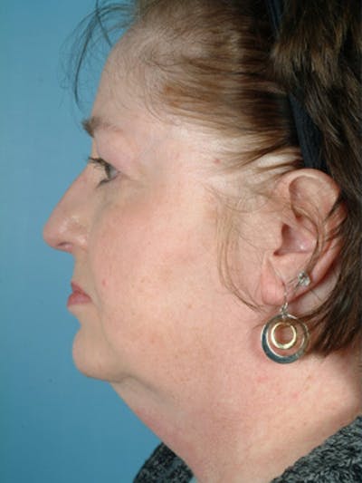 Neck Lift Before & After Gallery - Patient 238371 - Image 1
