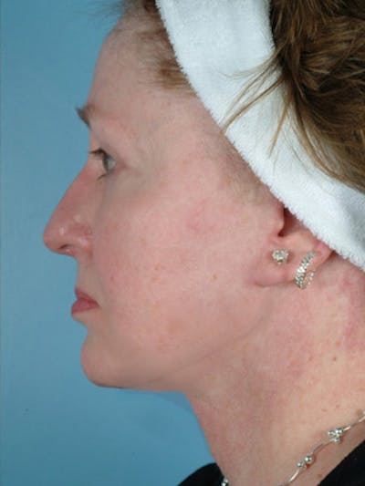 Liposuction Submental Before & After Gallery - Patient 412782 - Image 2