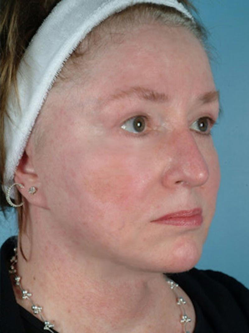 Liposuction Submental Before & After Gallery - Patient 412782 - Image 4