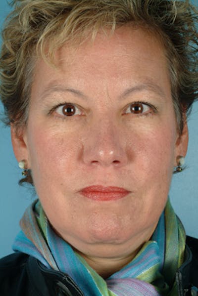 Upper Blepharoplasty Before & After Gallery - Patient 155657 - Image 1