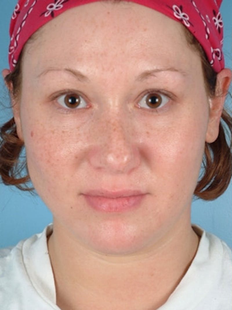 Rhinoplasty Before & After Gallery - Patient 393357 - Image 3