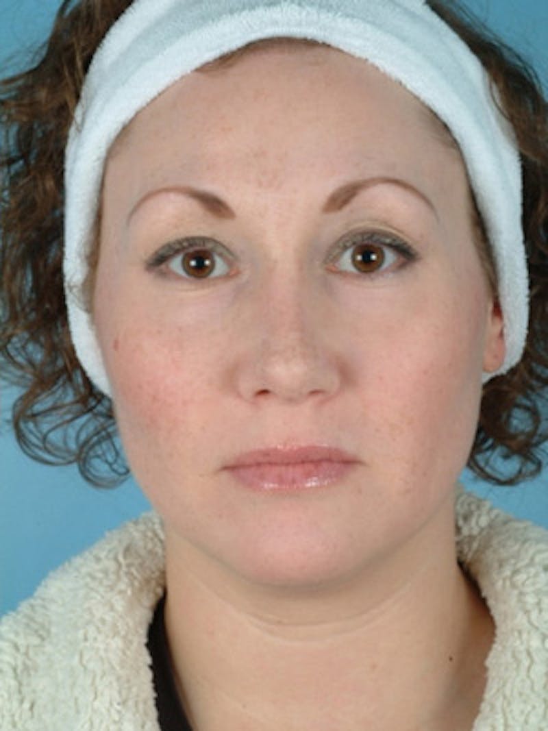 Rhinoplasty Before & After Gallery - Patient 393357 - Image 4