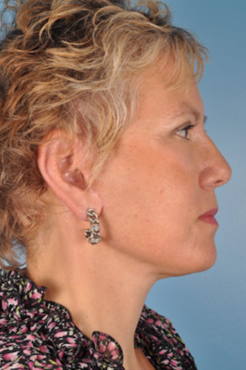 Neck Lift Before & After Gallery - Patient 151674 - Image 2