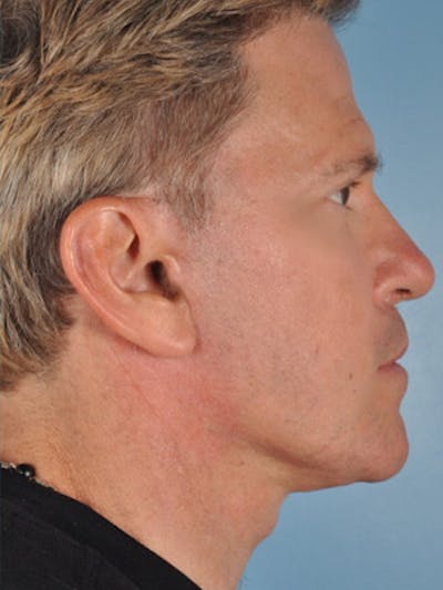 Rhinoplasty Before & After Gallery - Patient 250779 - Image 2